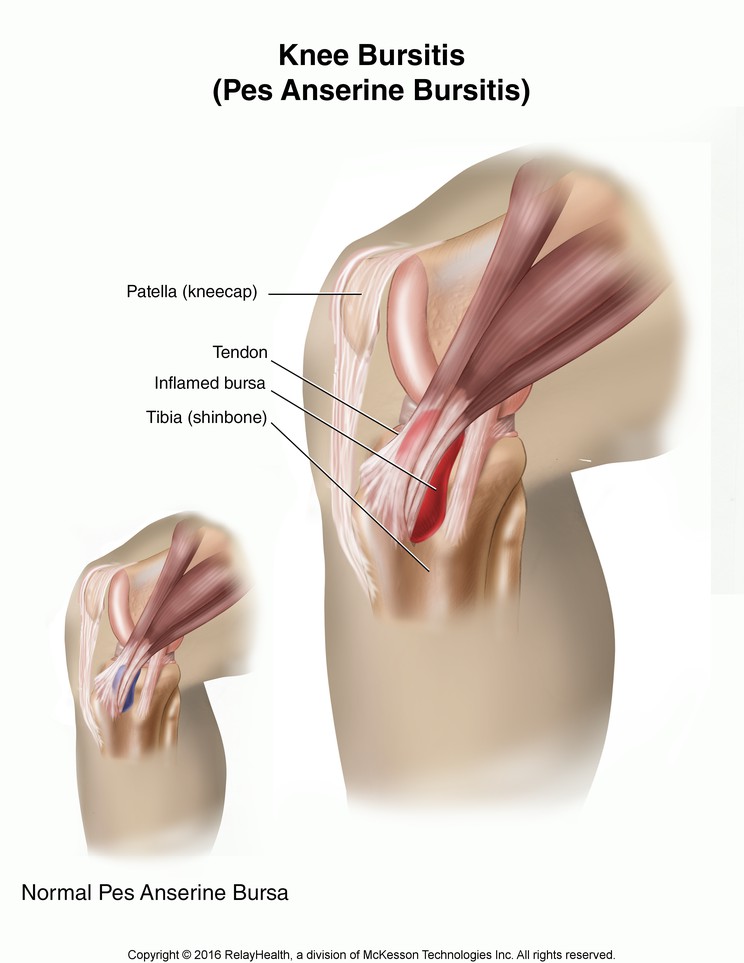 Knee Bursitis (Pes Anserine Bursitis): Illustration