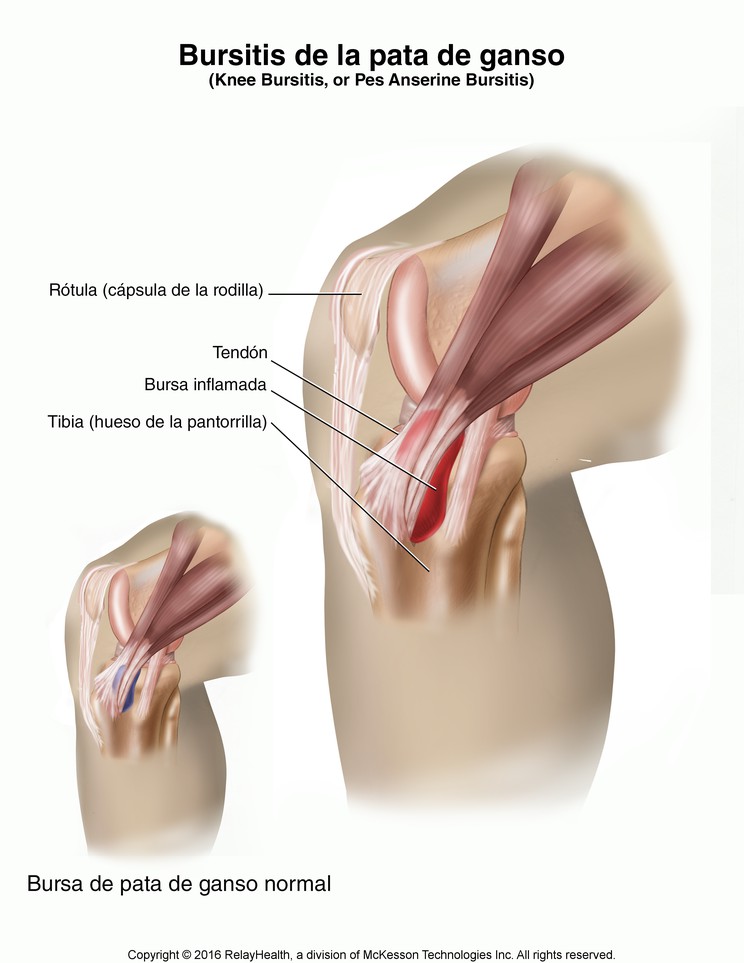 Knee Bursitis: Illustration
