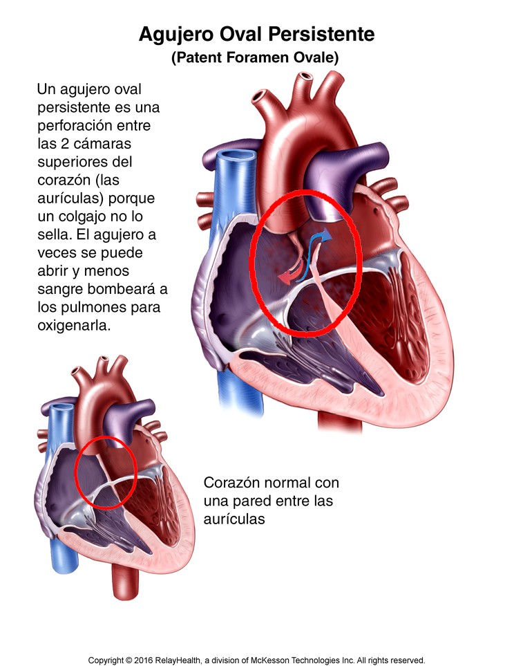 Patent Foramen Ovale: Illustration