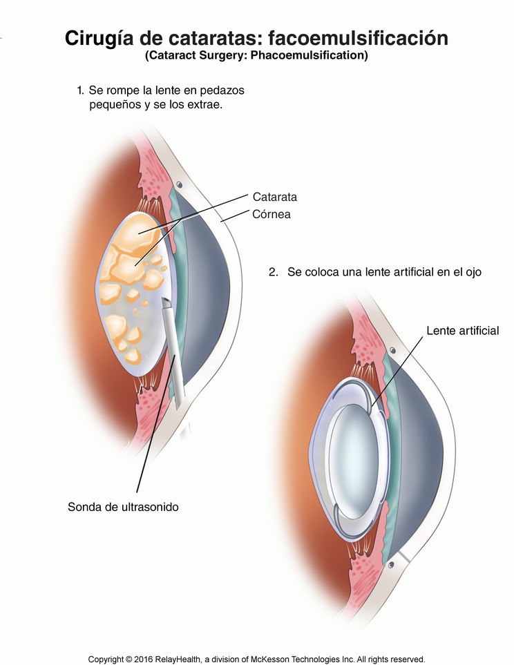 Cataract Surgery with Phacoemulsification: Illustration