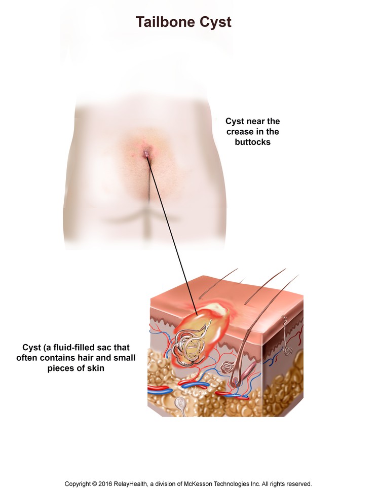 Tailbone Cyst: Illustration