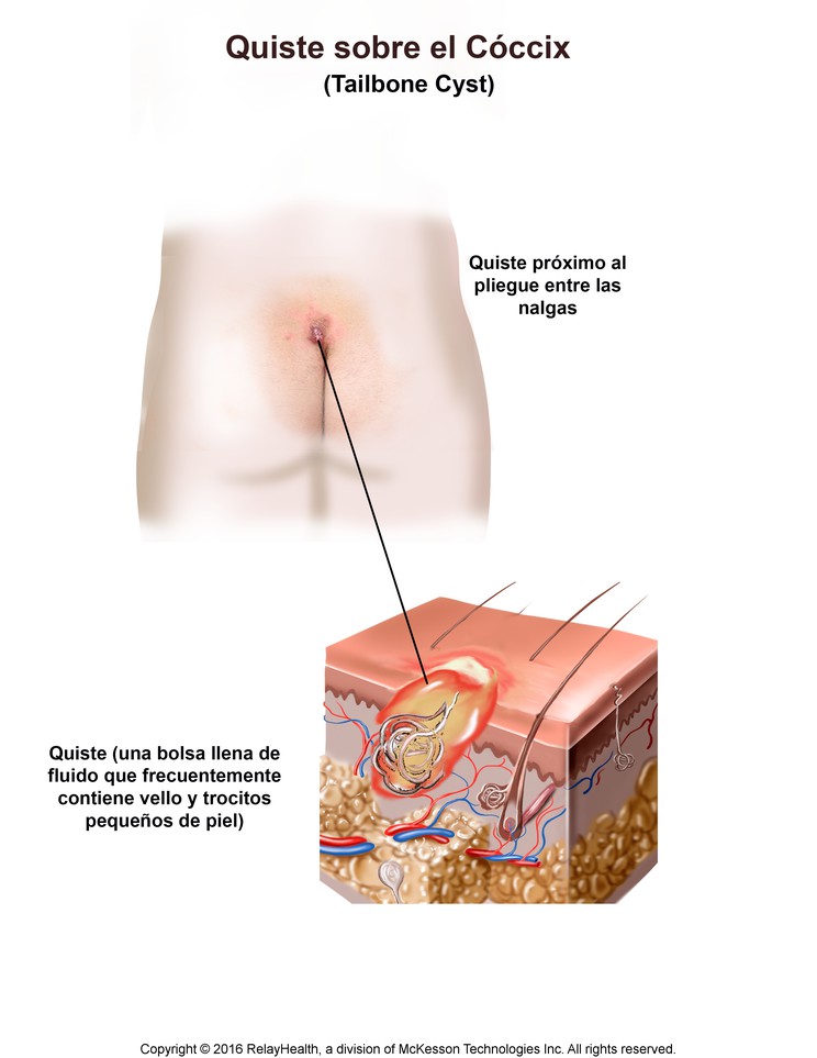 Tailbone Cyst: Illustration