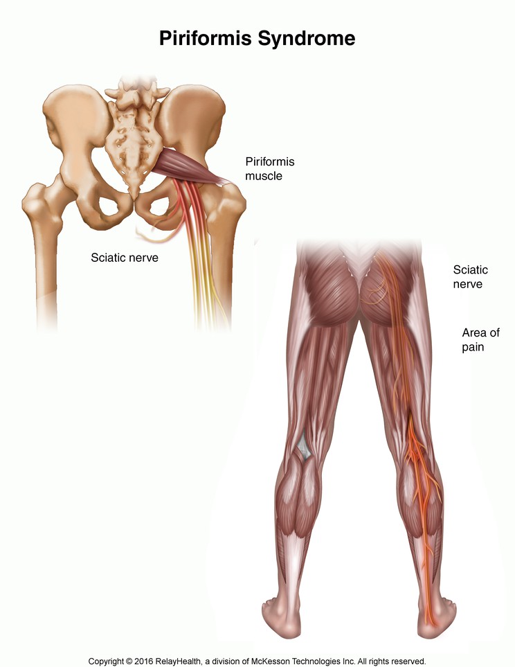 Piriformis Syndrome: Illustration