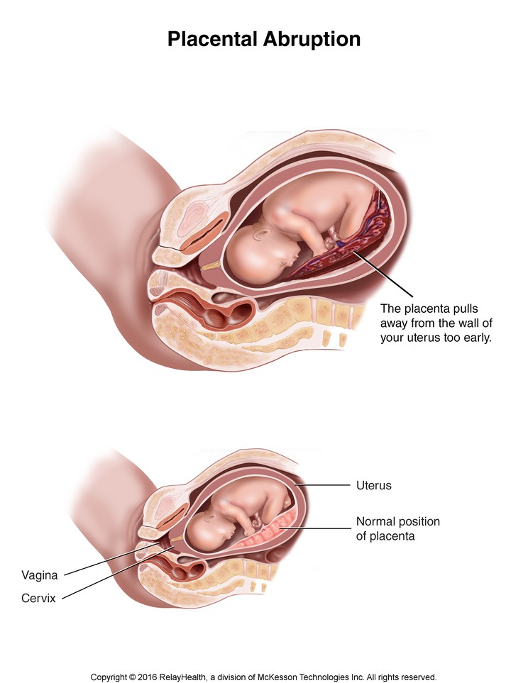 Placental Abruption: Illustration