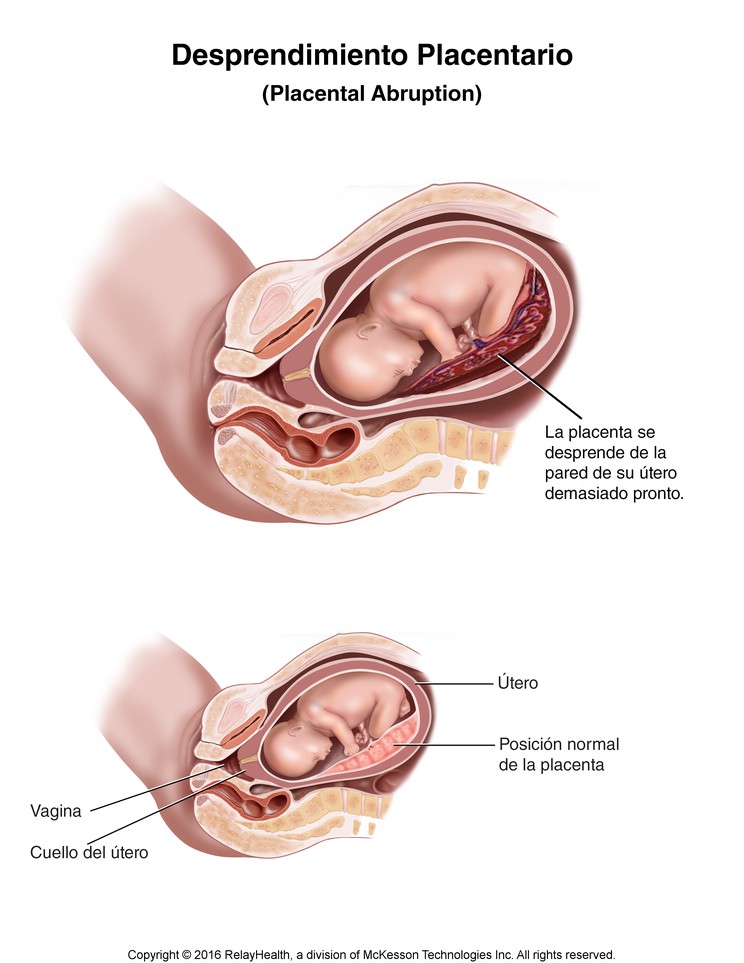 Placental Abruption: Illustration
