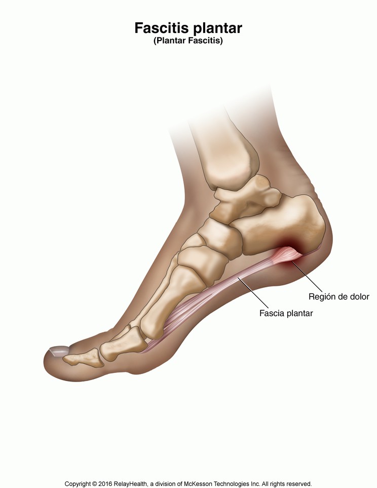 Plantar Fasciitis: Illustration