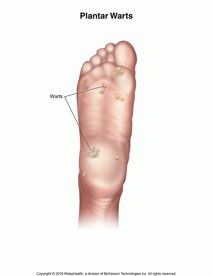 Plantar Warts: Illustration