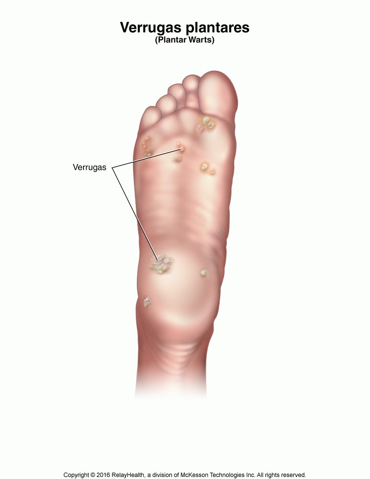 Plantar Warts: Illustration