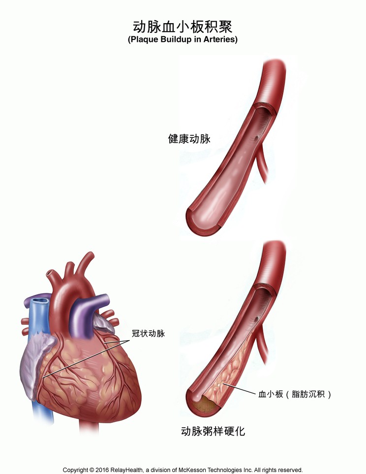 Plaque Buildup in Arteries: Illustration