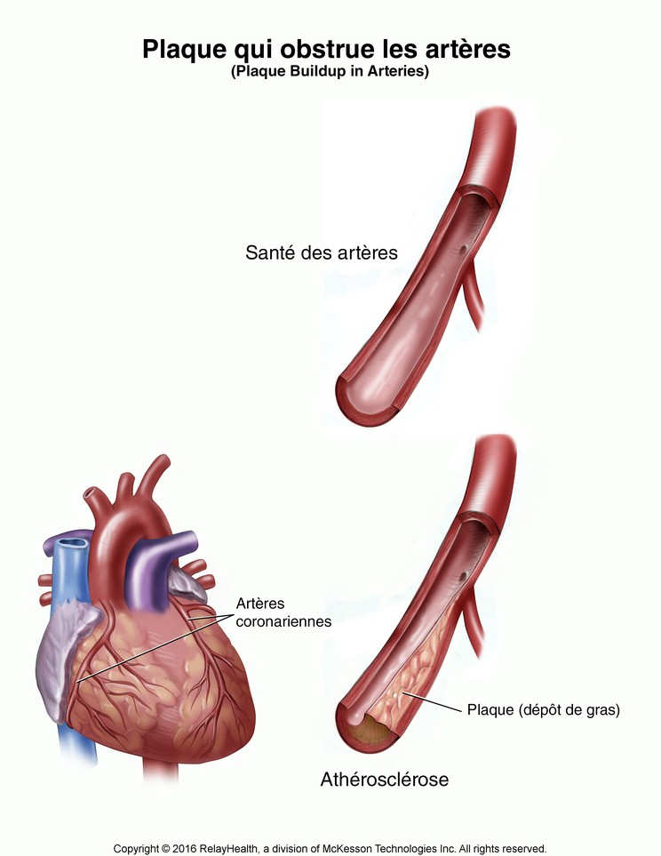 Plaque Buildup in Arteries: Illustration