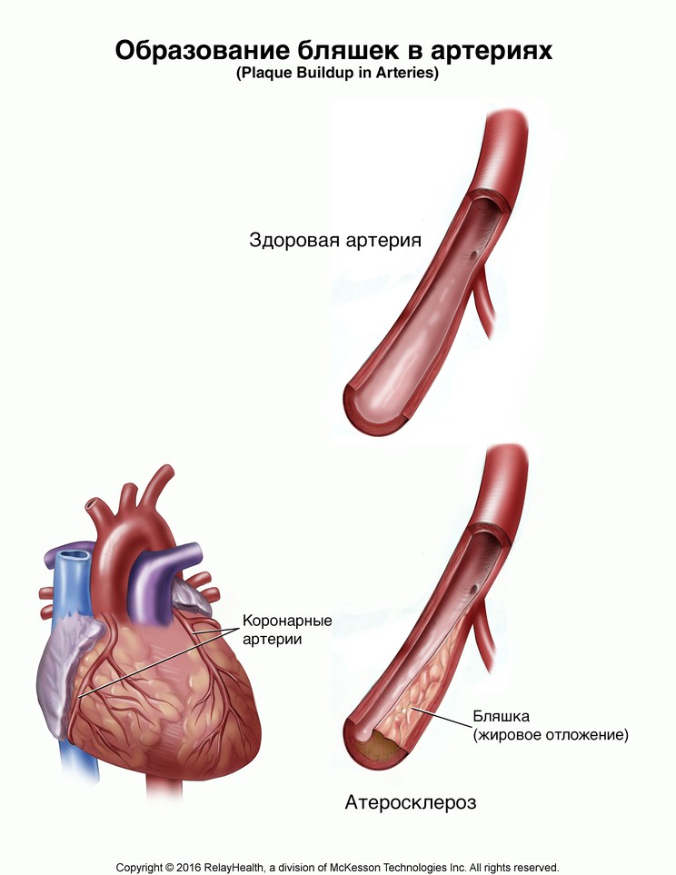 Plaque Buildup in Arteries: Illustration