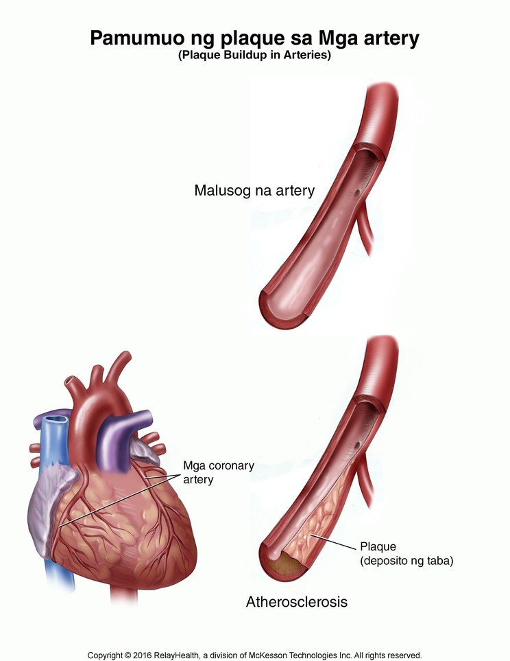 Plaque Buildup in Arteries: Illustration