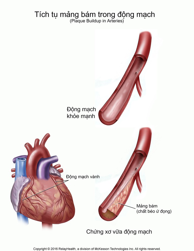 Plaque Buildup in Arteries: Illustration