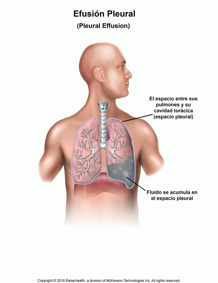 Pleural Effusion: Illustration
