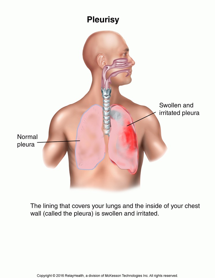 Pleurisy: Illustration