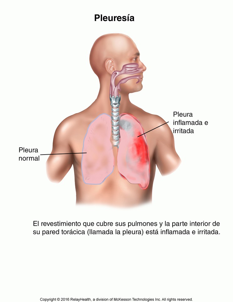 Pleurisy: Illustration