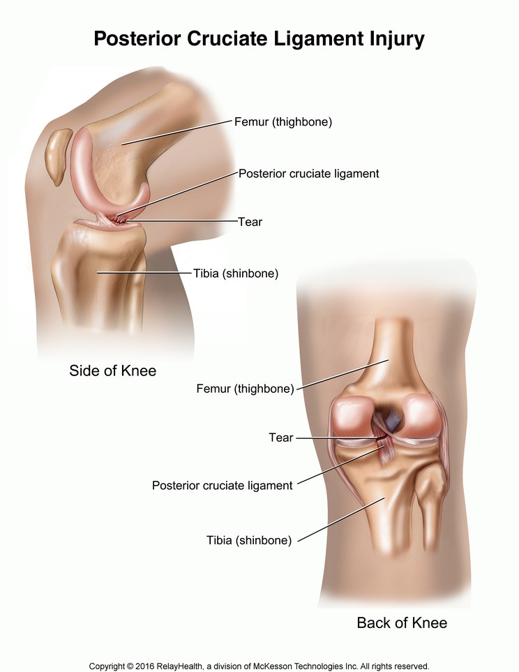Posterior Cruciate Ligament Injury: Illustration