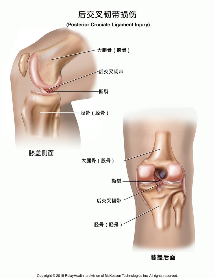 Posterior Cruciate Ligament Injury: Illustration