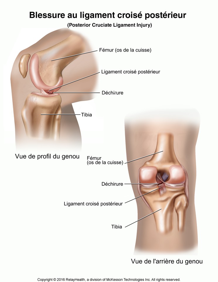 Posterior Cruciate Ligament Injury: Illustration