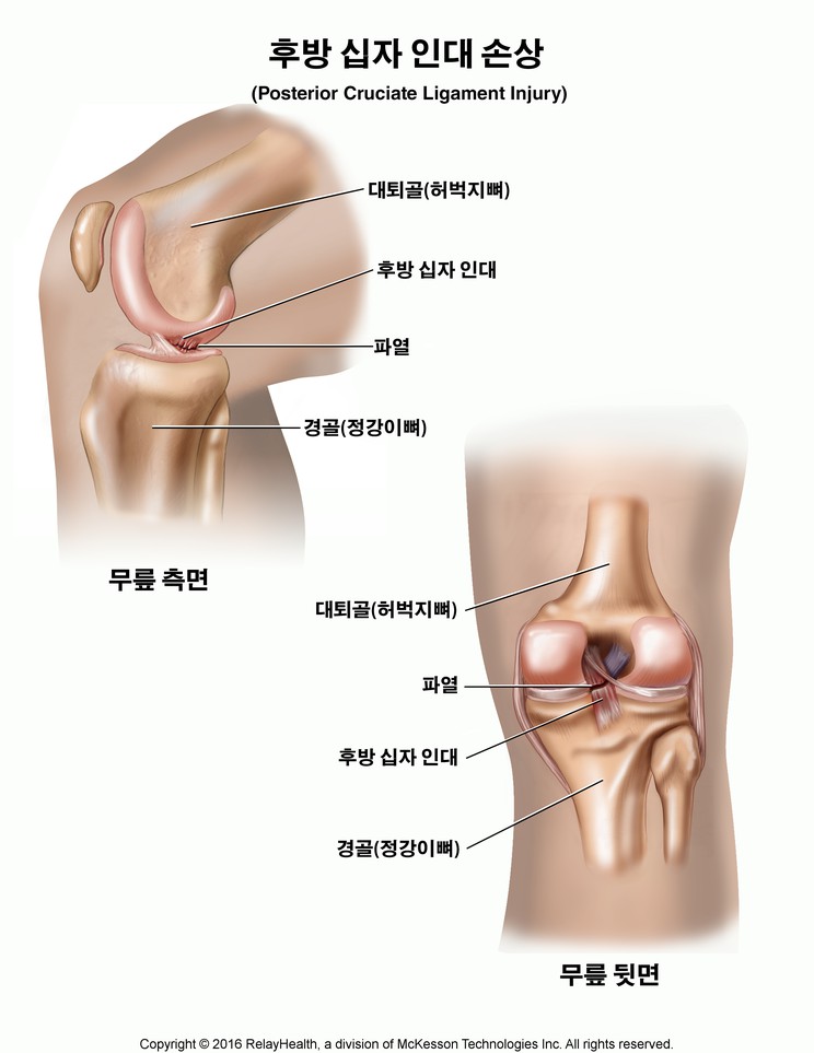 Posterior Cruciate Ligament Injury: Illustration