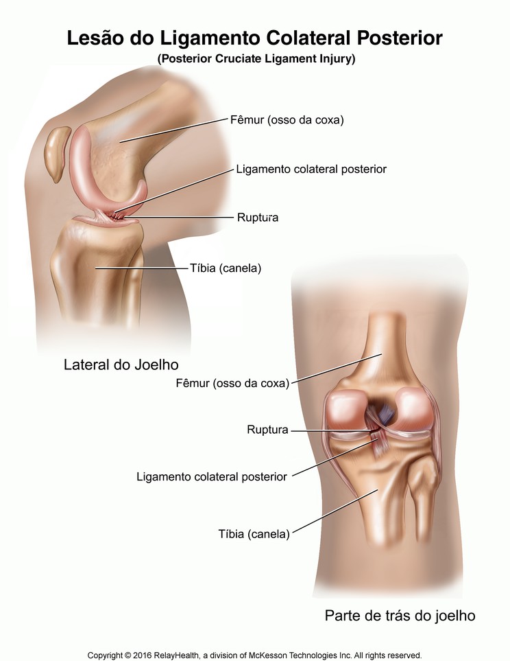 Posterior Cruciate Ligament Injury: Illustration