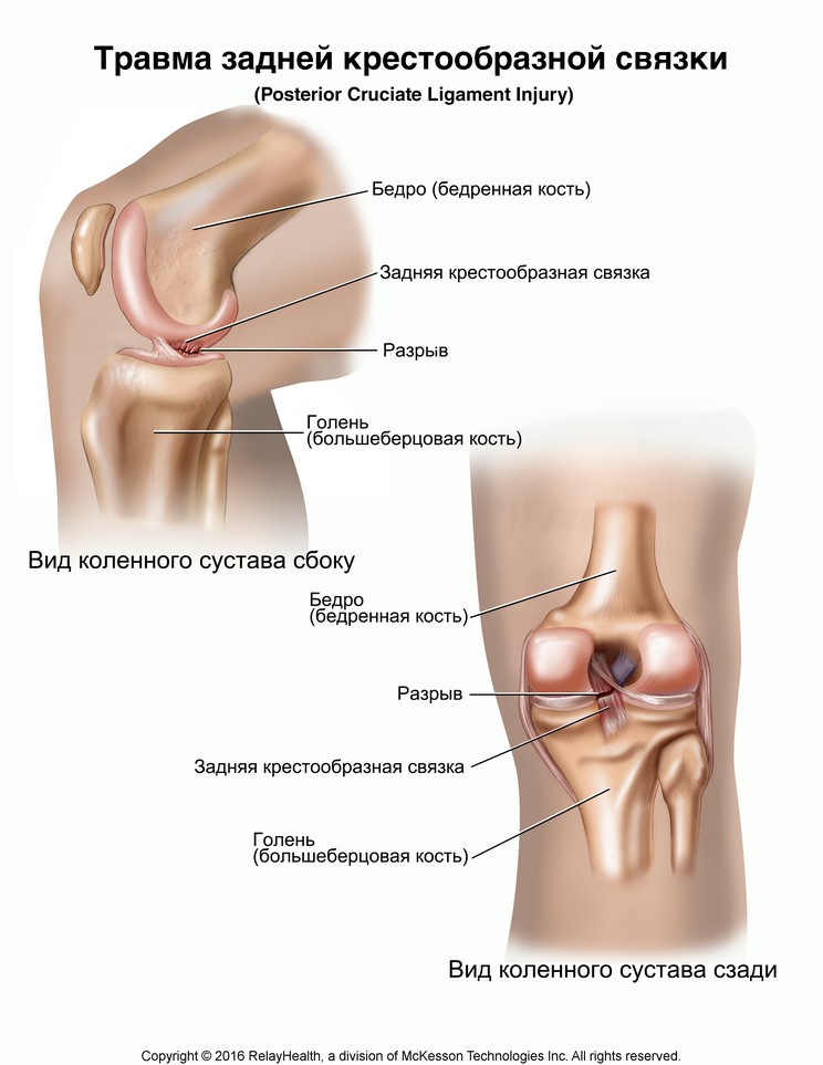 Posterior Cruciate Ligament Injury: Illustration