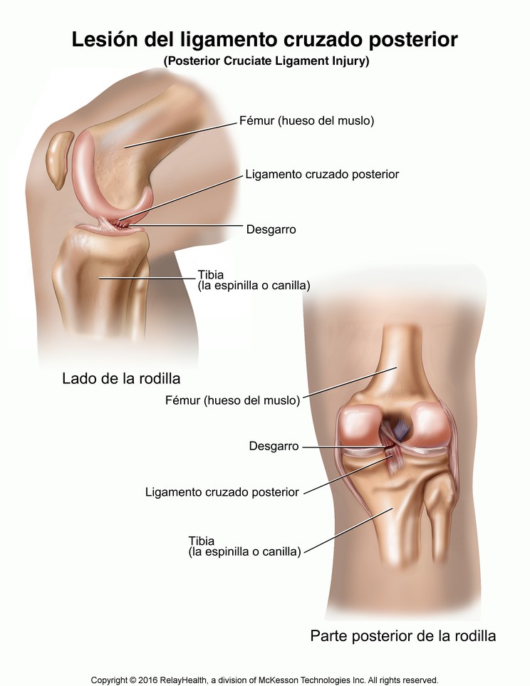 Posterior Cruciate Ligament Injury: Illustration