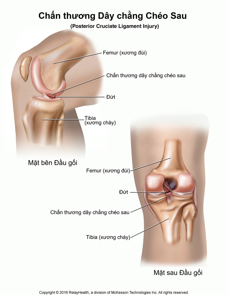 Posterior Cruciate Ligament Injury: Illustration