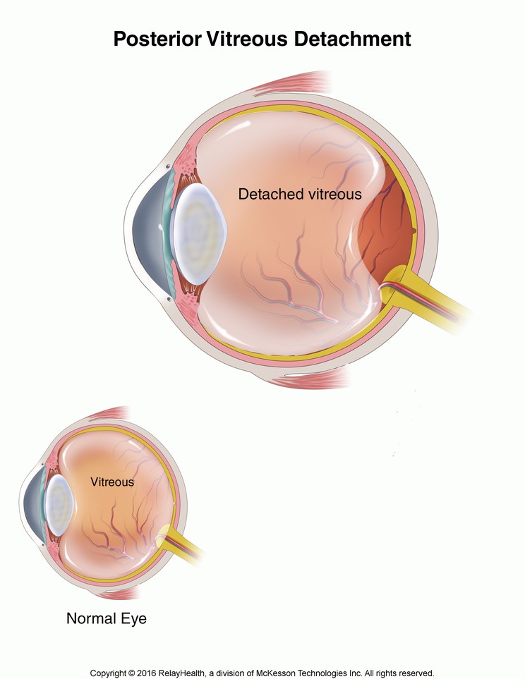 Posterior Vitreous Detachment: Illustration