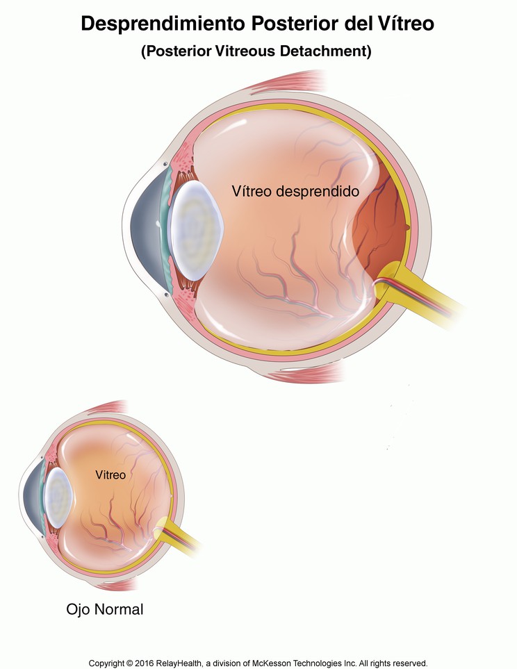 Posterior Vitreous Detachment: Illustration