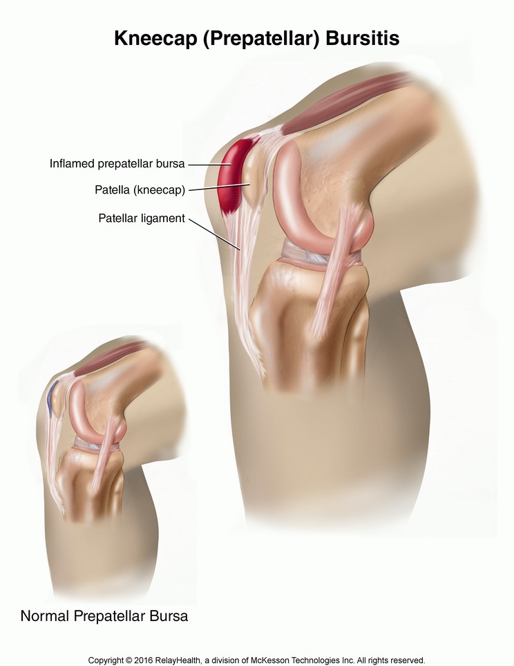 Kneecap (Prepatellar) Bursitis: Illustration