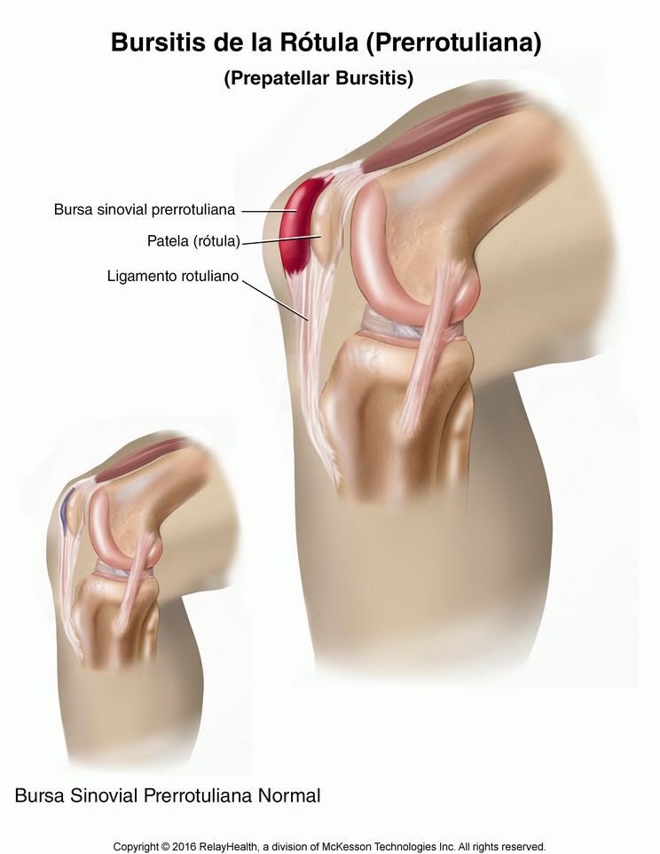 Kneecap (Prepatellar) Bursitis: Illustration