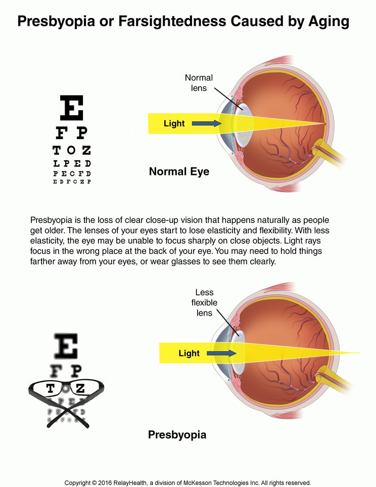 Presbyopia or Farsightedness Caused by Aging: Illustration