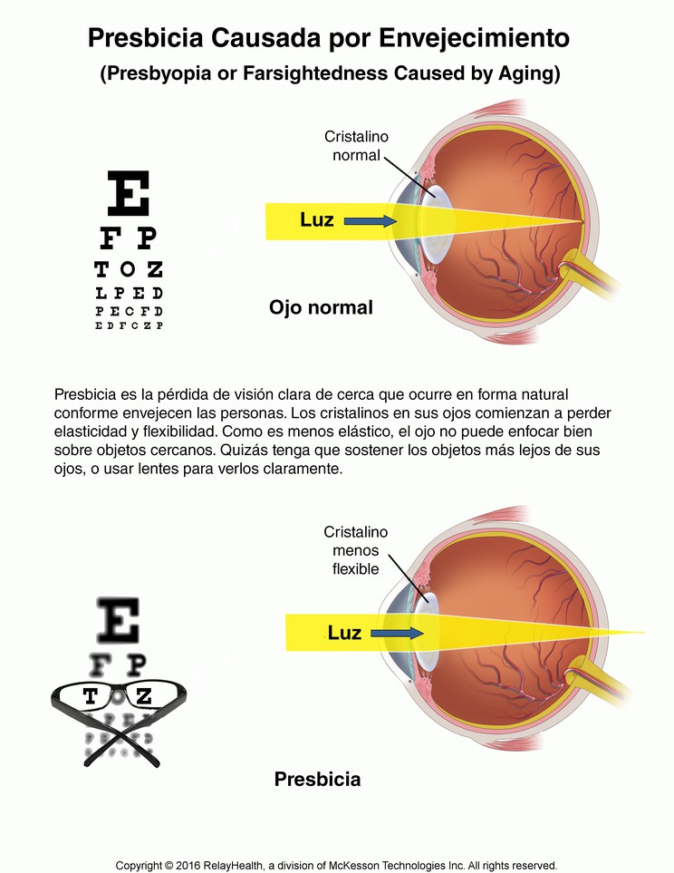 Presbyopia or Farsightedness Caused by Aging: Illustration