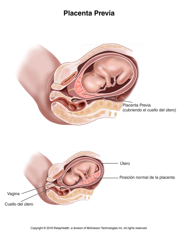 Placenta Previa: Illustration