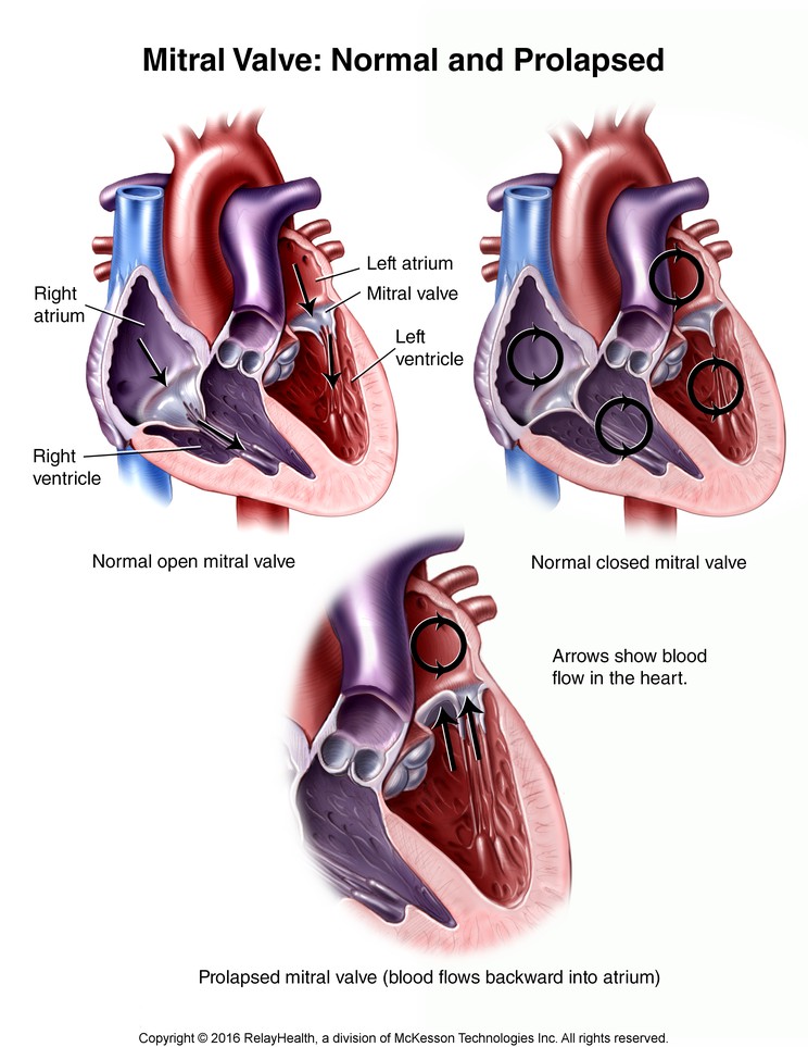 Mitral Valve, Normal and Prolapsed: Illustration