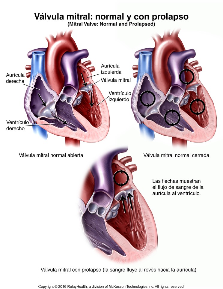 Mitral Valve, Normal and Prolapsed: Illustration