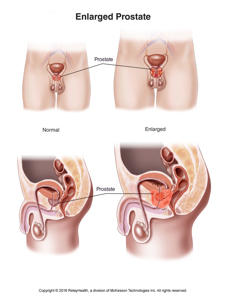 Enlarged Prostate: Illustration