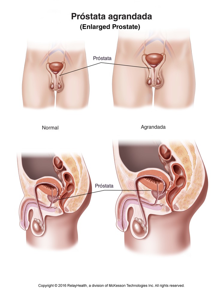 Enlarged Prostate: Illustration