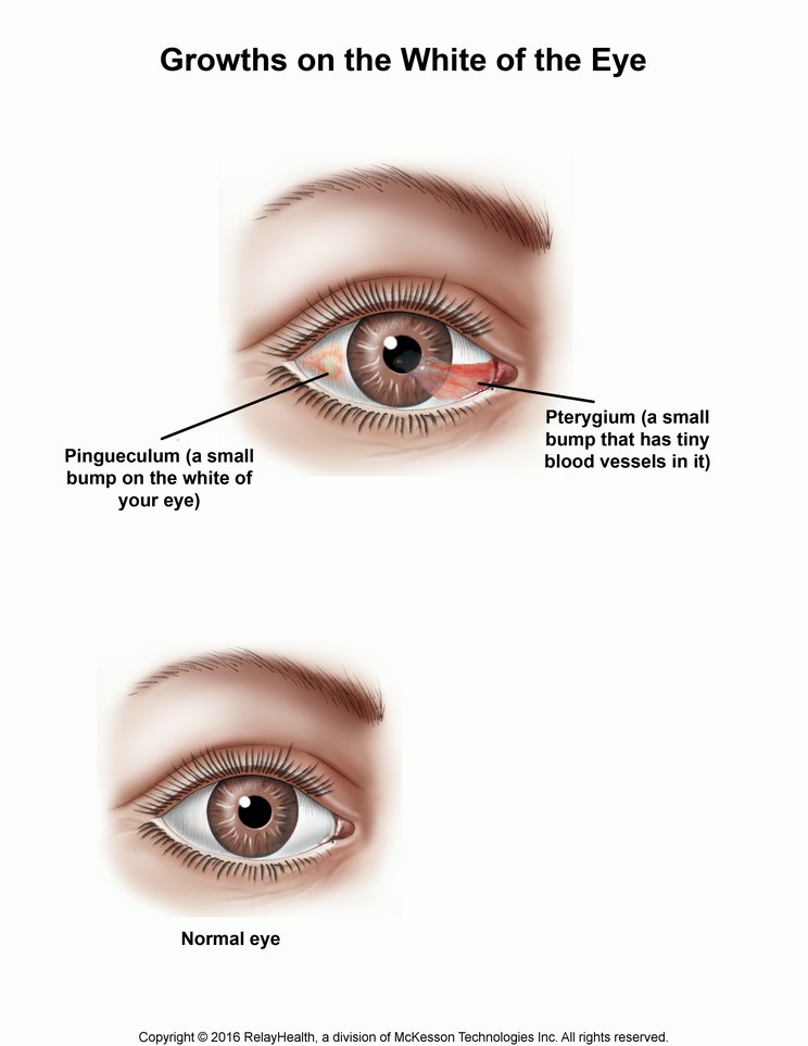 Growth on the White of the Eye: Illustration