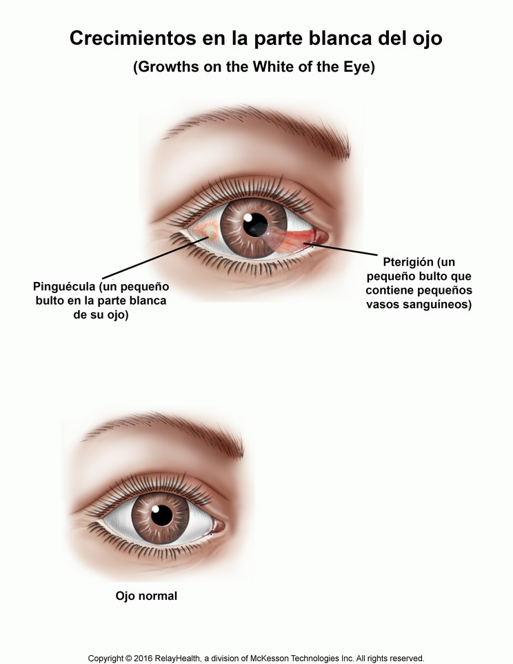 Growth on the White of the Eye : Illustration