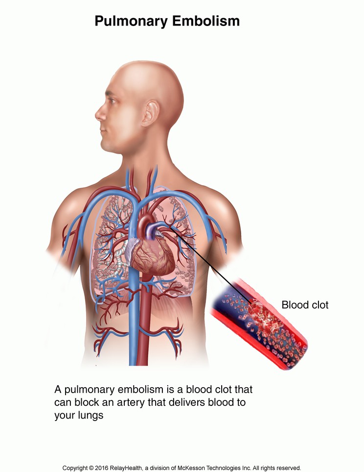 Pulmonary Embolism: Illustration