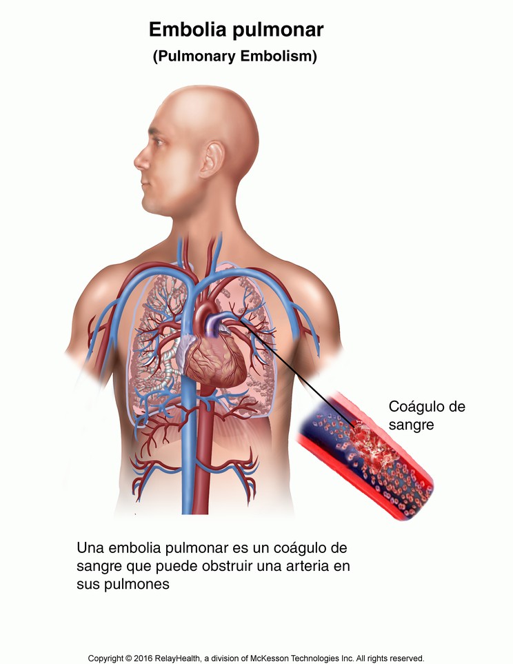 Pulmonary Embolism: Illustration