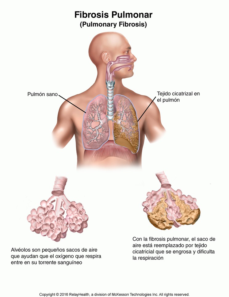 Pulmonary Fibrosis: Illustration