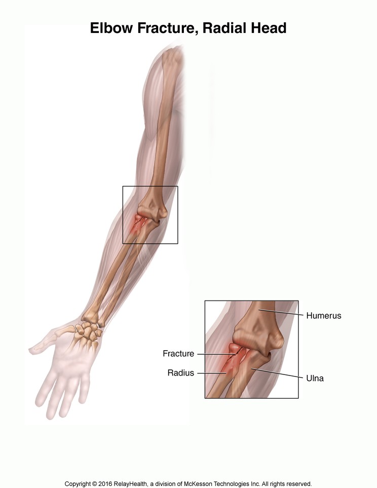 Elbow Fracture, Radial Head: Illustration