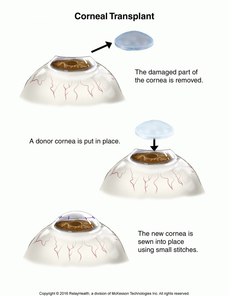 Corneal Transplant: Illustration