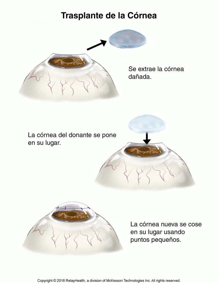 Corneal Transplant: Illustration