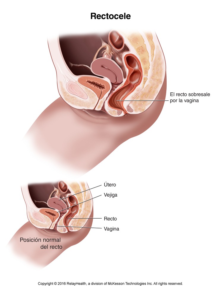 Rectocele: Illustration