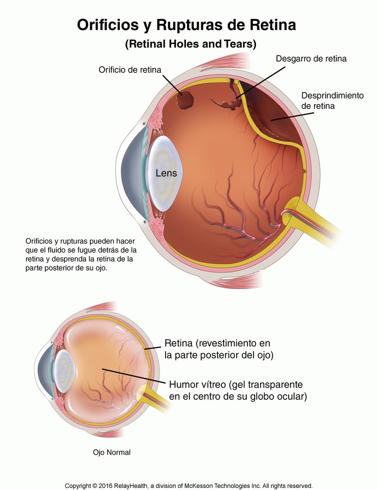 Retinal Holes and Tears: Illustration