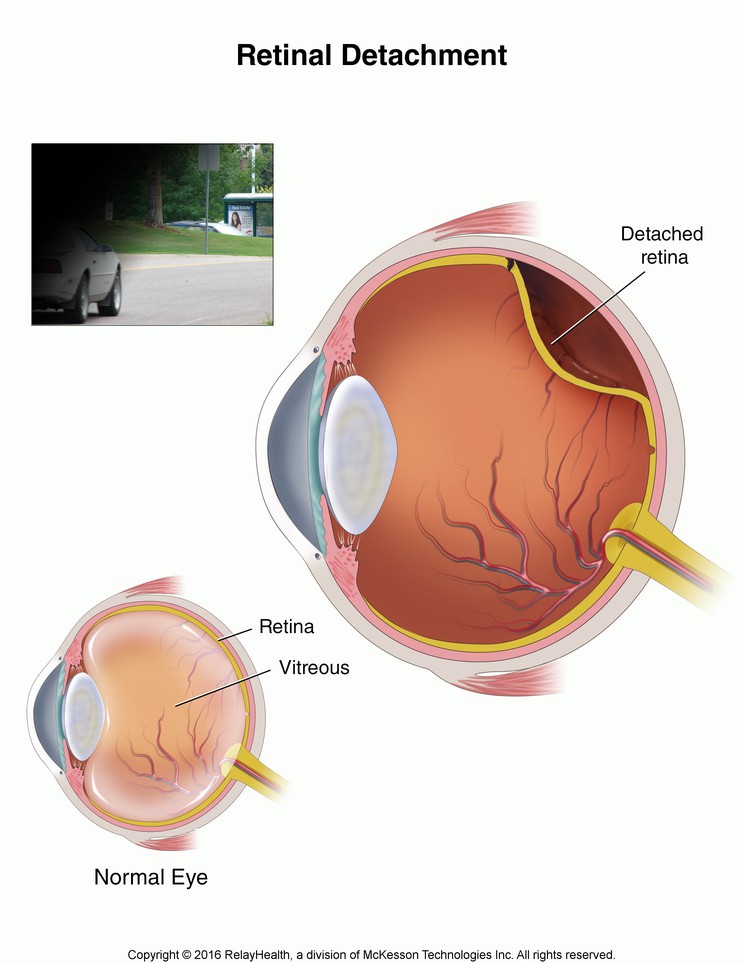 Retinal Detachment: Illustration